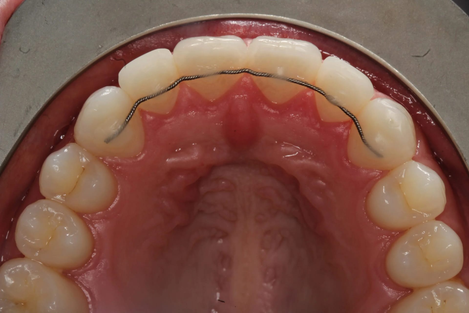 Visit a Hawthorn Orthodontist for Children’s Teeth Alignment Needs